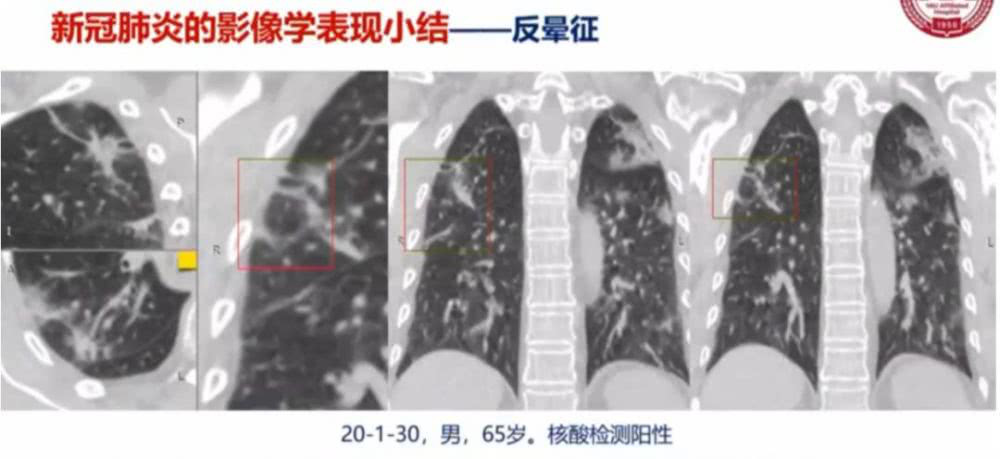 AI助力疫情防控，專(zhuān)利為其保駕護航！